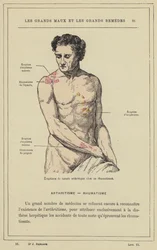 Arthritic Nature Eruptions in a Rheumatic Person