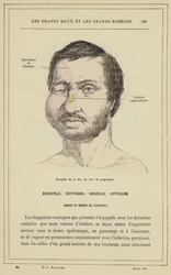 Progressing Facial Erysipelas