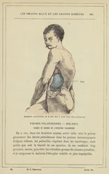 Characteristic Swelling of the Spleen During a Malarial Fever
