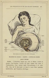 Areolar cyst of the right ovary at its complete development
