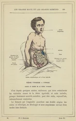Characteristic Lesions of Typhoid Fever