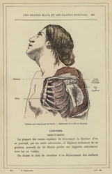 Subcoracoid dislocation of the shoulder, displacement of the head of the humerus