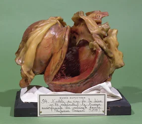 Model of a tumour of the left ventricle, 1799
