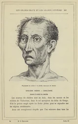 Appearance of the Patient in the Asphyxial Stage of Cholera