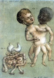Medical plate depicting Siamese twins: a white and a Black person. Illustration by Toussaint (1756) in „Observations périodiques sur la physique, l