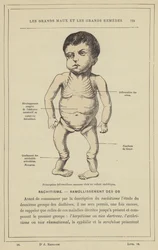 Main Bone Deformations in a Rachitic Child