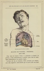 Severe Outcomes of Chest Fluxion
