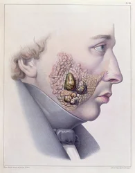 The facial symptoms of venereal disease, from Traite Complet des Maladies Veneriennes by Philippe Ricord
