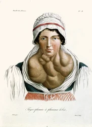 Thyroid disease, from a book by Baron Jean Louis Alibert 1817