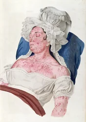 Woman with scarlet fever, from a book by Baron Jean Louis Alibert engraved by Choupard, 1833