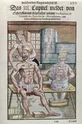 Cupping, from Ophthalmodouleia by Georg Bartisch published in Dresden in 1583