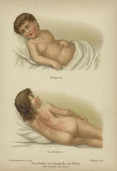 Early symptoms of measles and scarlet fever