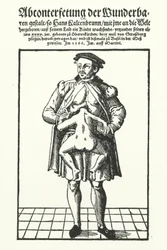 Hans Kaltenbrunn and his undeveloped conjoined twin (engraving)
