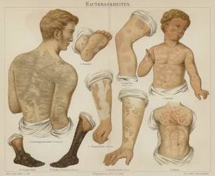 Skin disorders