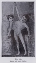 Giacomo and Giovanni Battista Tocci, Italian Conjoined Twins