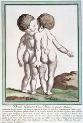 Siamese children - in 