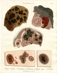 Pathological Skin Changes: Porriga and Ecthyma
