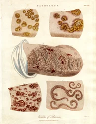 Pathological Skin Changes: Varieties of Psoriasis