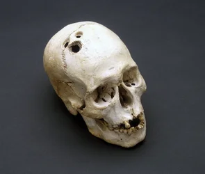 Trephination Bronze Age skull, Jericho, Palestine, 2200-2000 BC