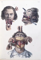 Operation on the lower jaw, plate from 
