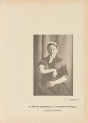Cerebral Atrophy: Partial Epilepsy Right Hemiplegia