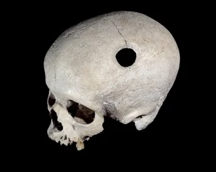 Prehistoric skull with trepanation trace, Museum of National Antiquities