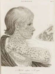 Two Types of Measles