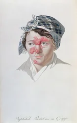 Syphilic Cluster Pustules, from a Book by Baron Jean Louis Alibert, 1838