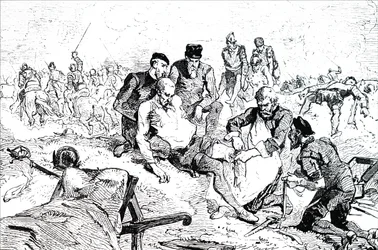 Ambroise Pare tying off arteries after amputation