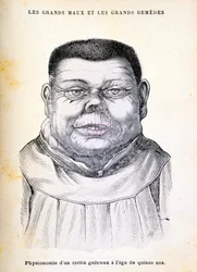 Cretin Aged 15