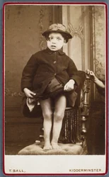 Diseases, Rickets Child with rickets