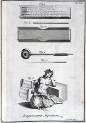 Acupuncture Needles and Their Application, c. 1690, Engraving by G. van der Gucht
