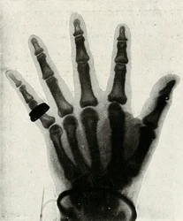 Radiograph of the Hand of H.R.H. The Prince of Wales