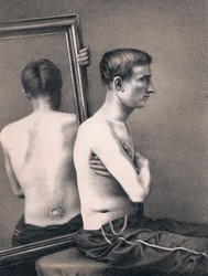 Recovering Casualty of a Bullet Wound to the Abdomen, American Civil War
