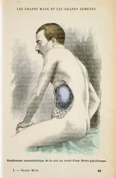 Typical Enlarged Spleen of a Malaria Patient