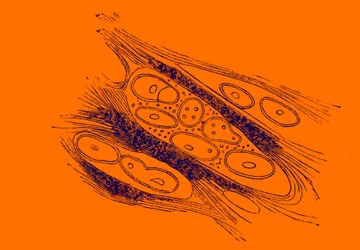 Cross section of a melanoid cancer