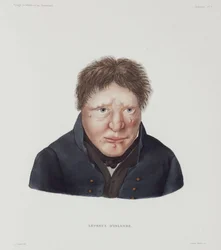 Diseases, Leprosy Male leper, Iceland, early 19th century