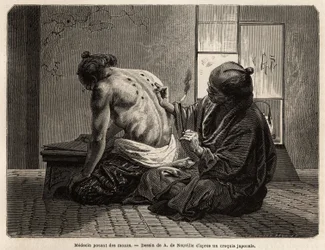 A doctor posing moxas (small sagebrush cones burned in specific parts of the body), a preventive treatment against various symptoms from indigestion to lack of appetite, crying and toothache, employed twice a year and has fixed time by the Japanese. Engrav