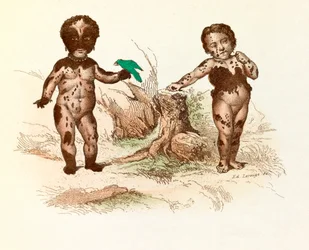 Little Girl Covered with Hairy Spots (engraving)