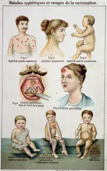 Plate illustrating the different forms of syphilitic diseases and the dangers of vaccination in 