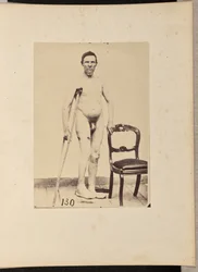 Consolidated Gunshot Fracture of the Middle Third of the Right Femur