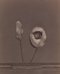 Excised Knee Joint. A Round Musket Ball in the Inner Condyle of the Right Femur