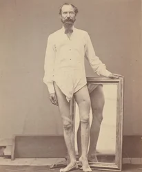 Gunshot Wound of Middle Third of Left Femur